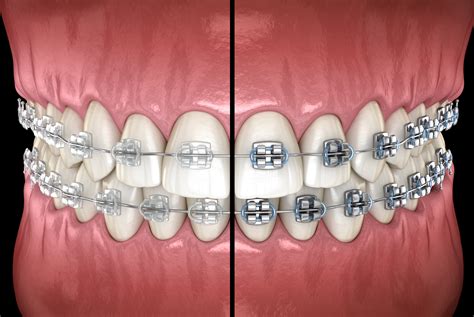 ceramic vs ceramic braces